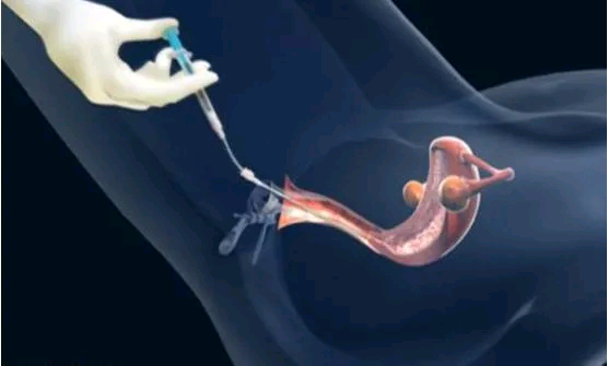 深圳赠卵试管医院 深圳生殖机构做供卵试管的有多少家 ‘怀孕初期胎囊在宫腔